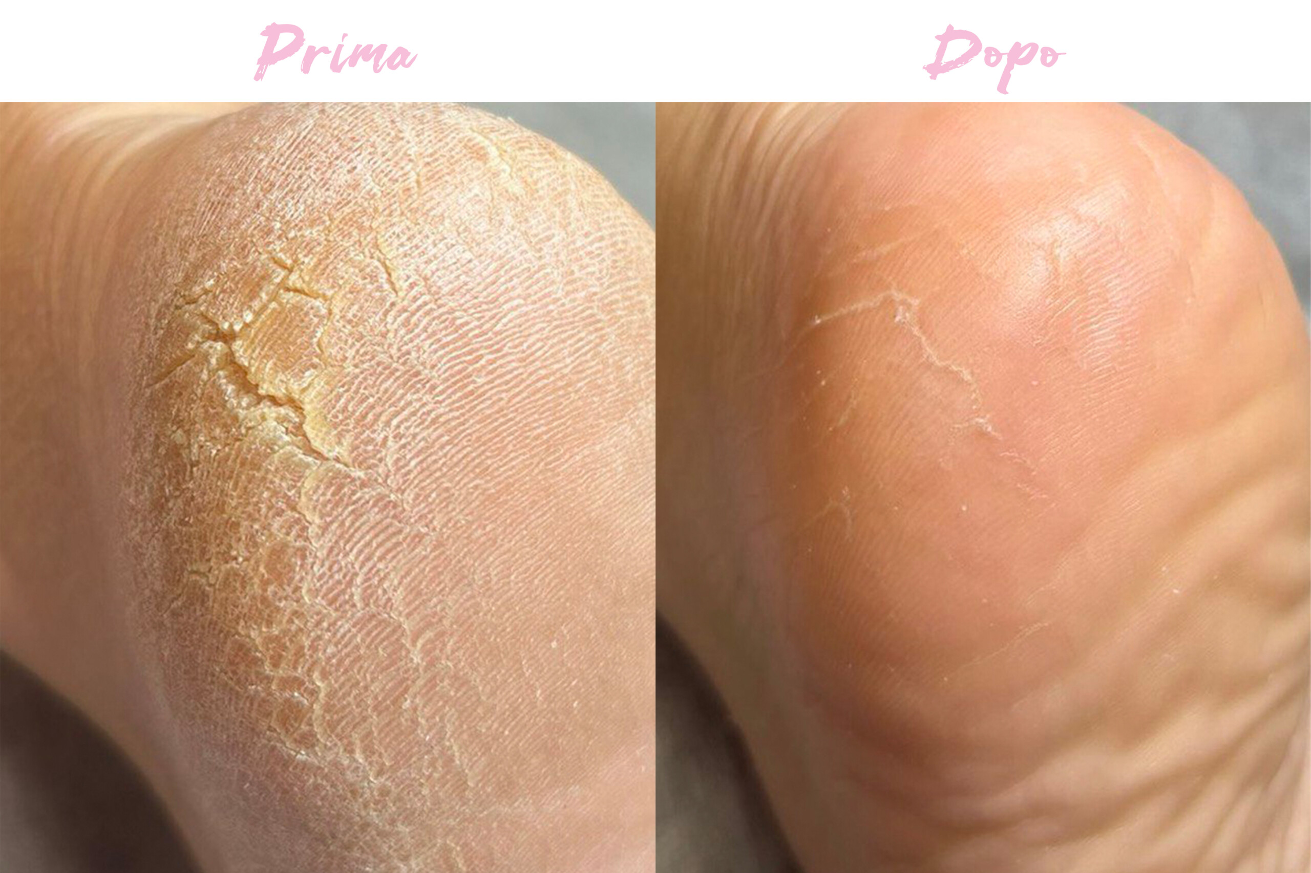 Prima-Dopo Piedi 1