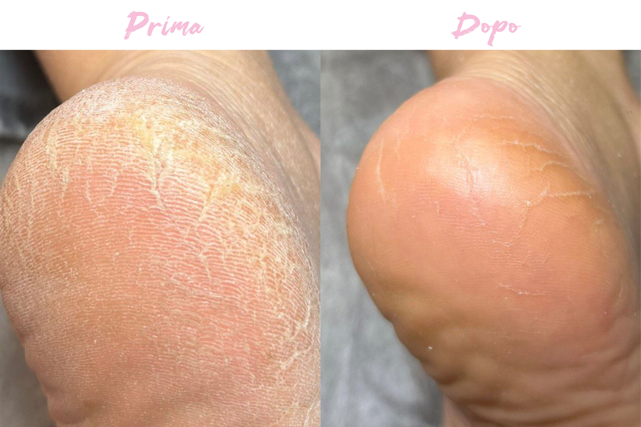 Prima-Dopo Piedi 2