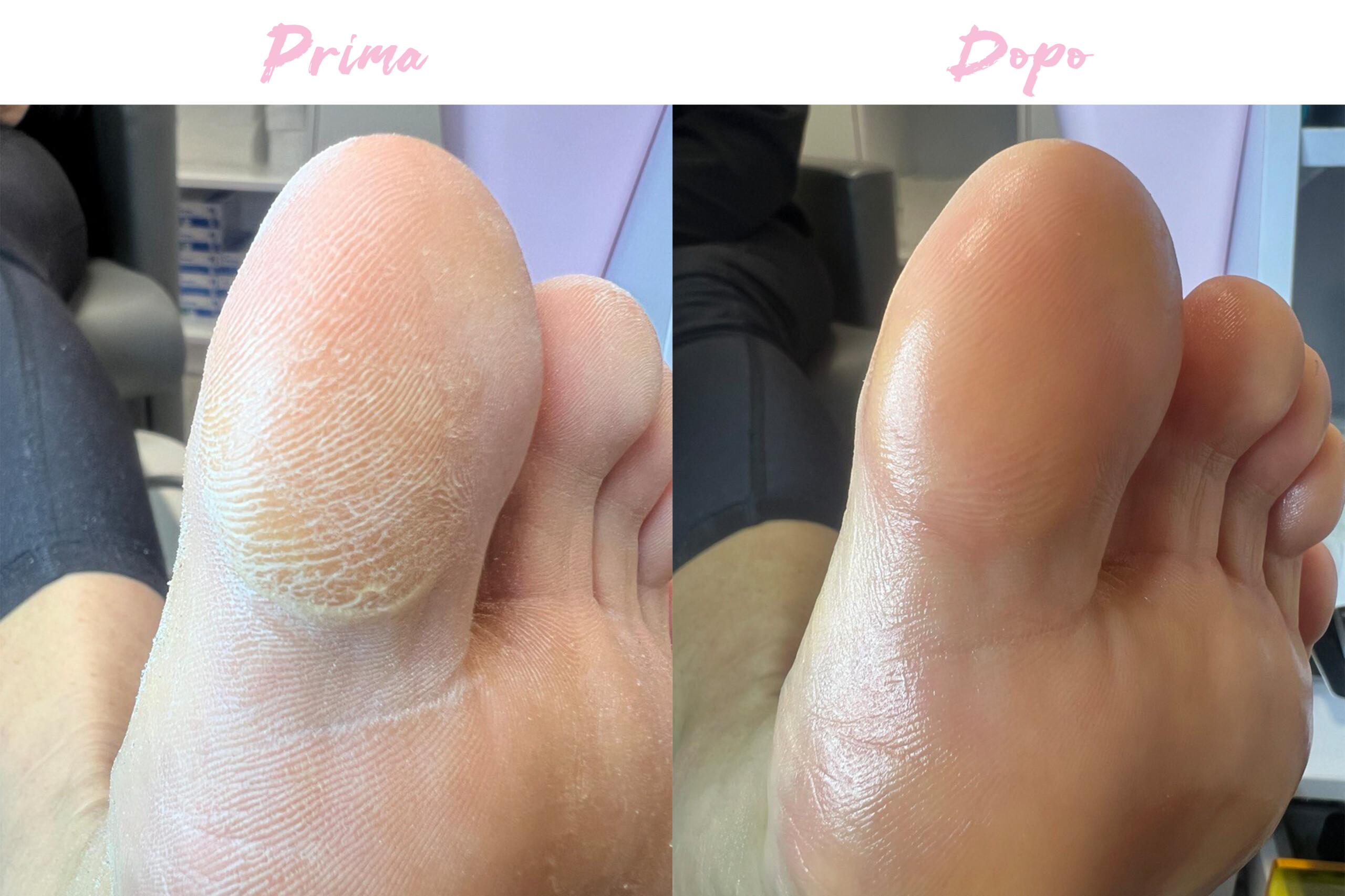 Prima-Dopo Piedi 3