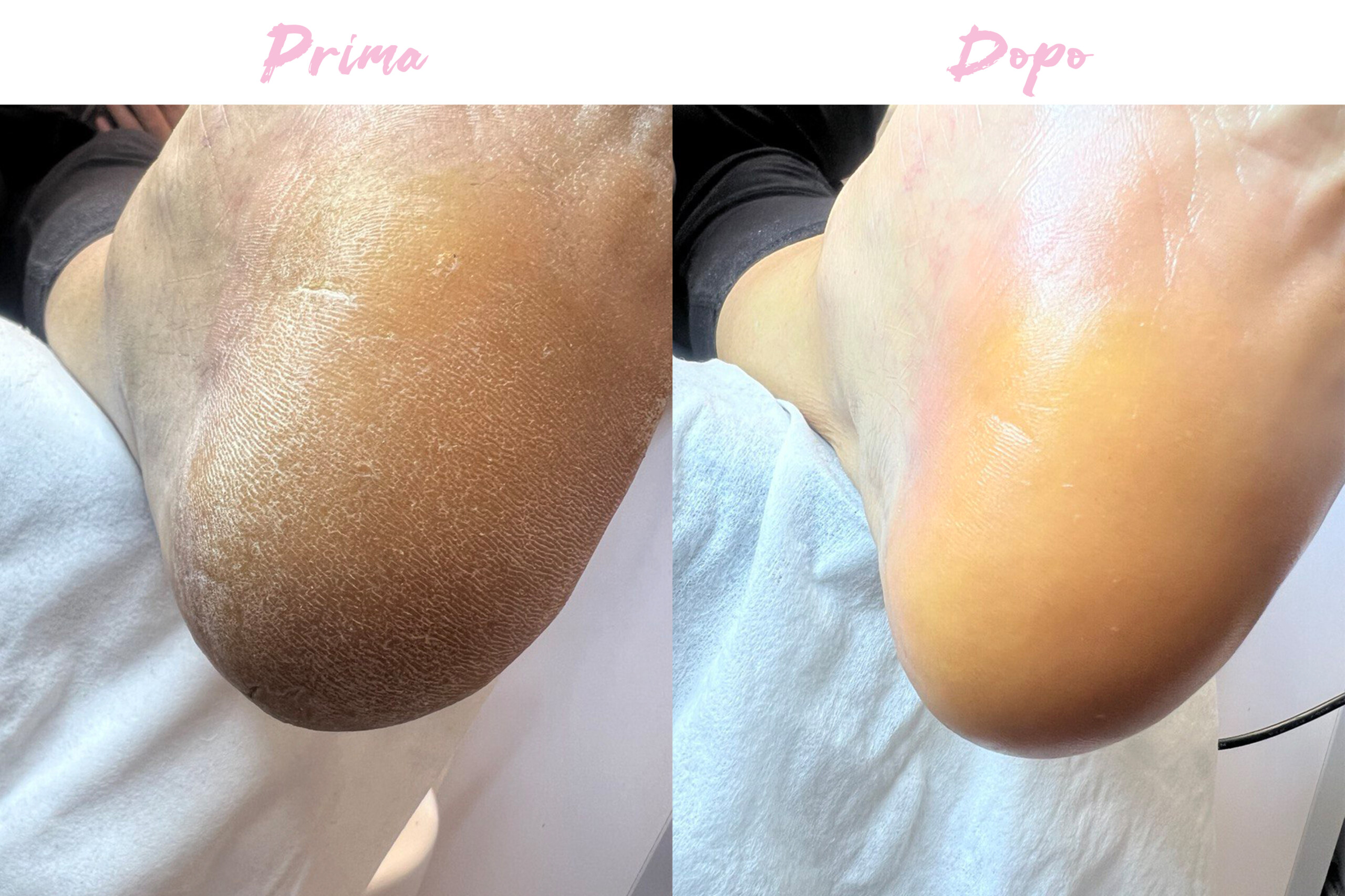 Prima-Dopo Piedi 4