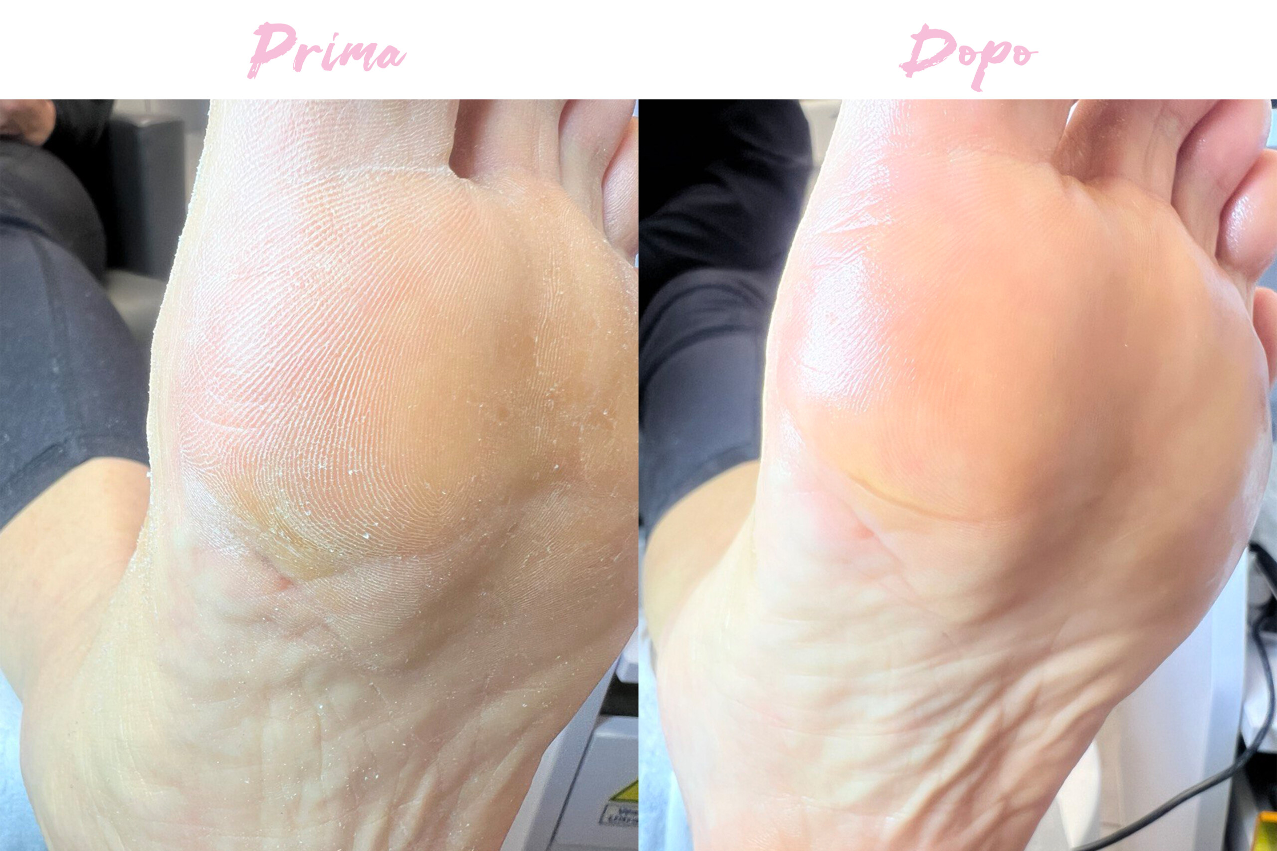 Prima-Dopo Piedi 5