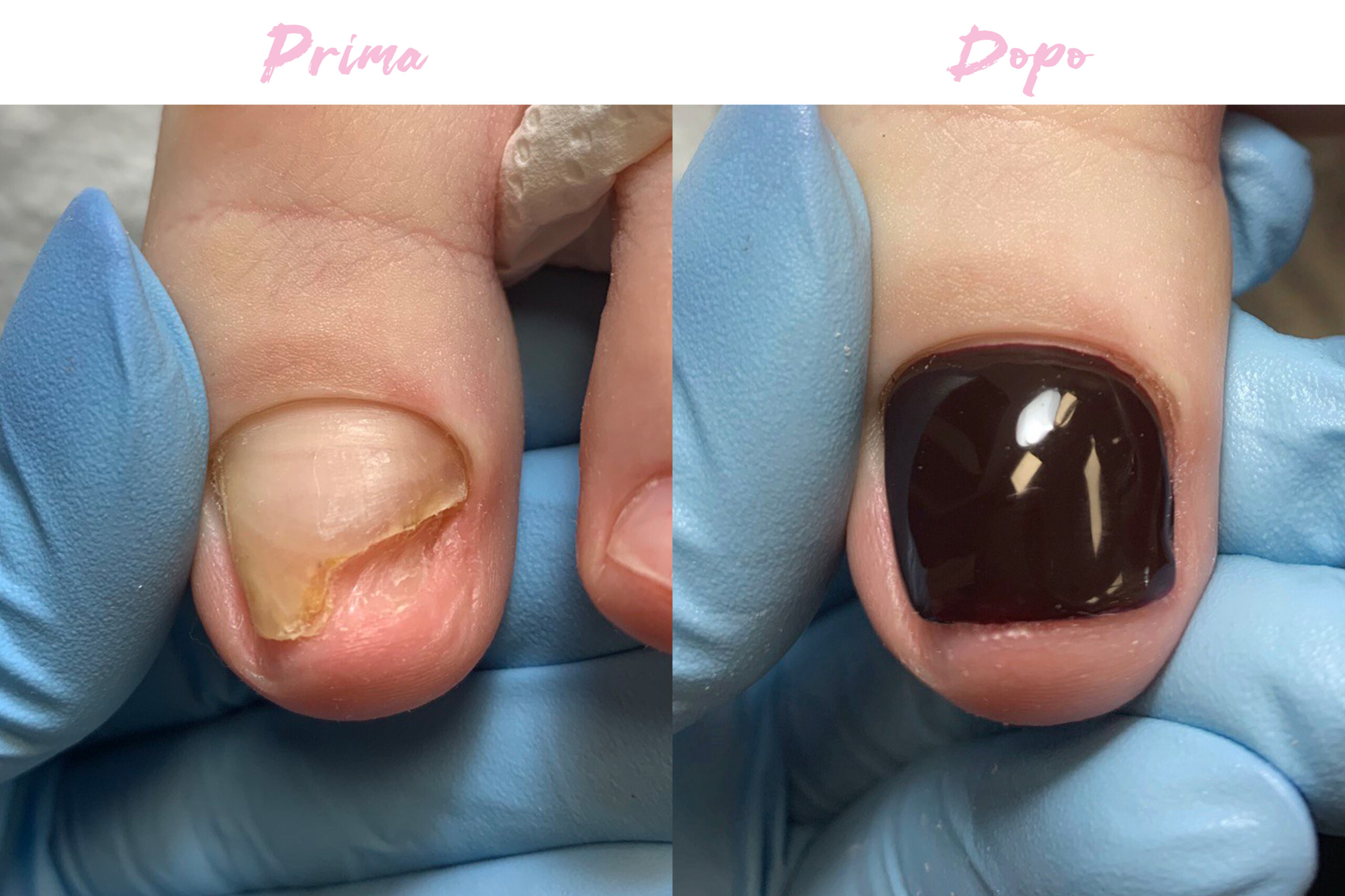 Prima-Dopo Piedi 6